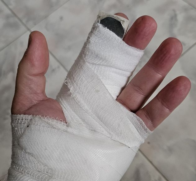 ЧП на рынке "Тальпиот". Перелом, оскорбления и тишина вокруг: жертва ищет справедливость